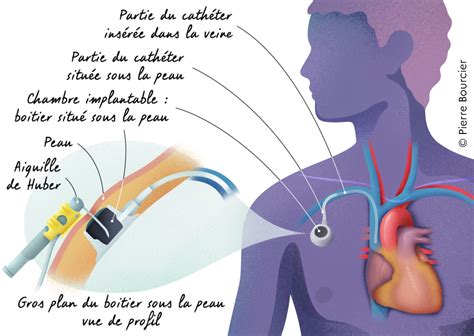 Cancers Du Pancréas Les Traitements Anticancéreux Chimiothérapie