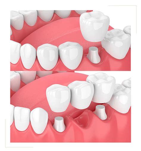 Prothèse Amovible Et Fixe Châteaurenard Dentiste Châteaurenard