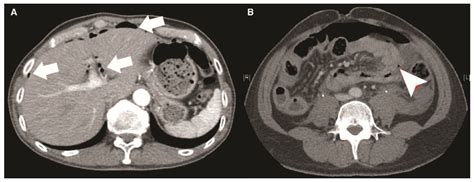 Abnormal Abdominal Ct Scan Icd 10