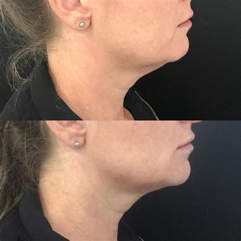 Non Surgical Jowl Lift Jowl Treatment To Tighten Jowls Filler For Jowls