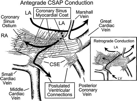 Coronary Sinus Ventricular Accessory Connections Producing