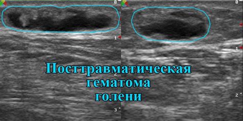 Как выглядит гематома мягких тканей на узи фото презентация