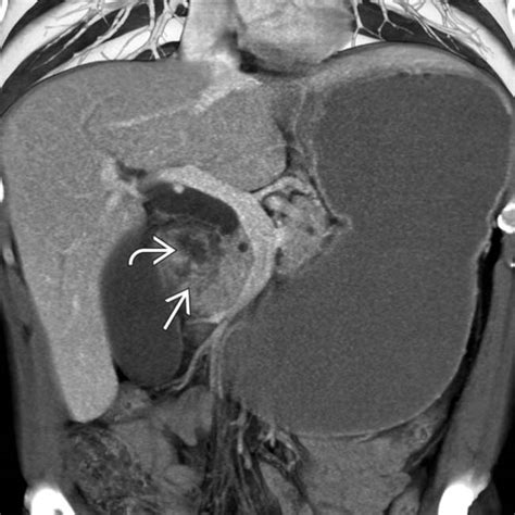 Groove Pancreatitis | Clinical Gate