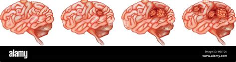 Las Diferentes Etapas Del Cáncer En El Cerebro La Ilustración Imagen