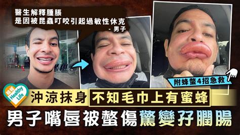 蚊叮蟲咬︳沖涼抹身不知毛巾上有蜜蜂 男子嘴唇被螫傷驚變孖膶腸︳附4招急救 晴報 健康 其他疾病 D211022