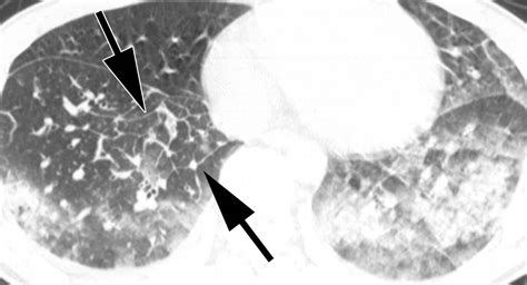 Eosinophilic Lung Diseases A Clinical Radiologic And Pathologic