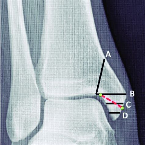 Medial Malleolus Fracture Lines Classified By Herscovici Types A B C Download Scientific