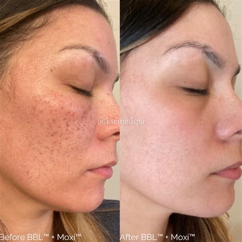 BBL Moxi Total Skin Rejuvenation Kingwood Skin Essentials