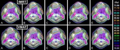 Dose Distributions In A Transverse Slice For Imrt And Vmat Plans Of All