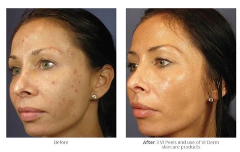 Vi Peel Before And After Darst Dermatology Charlotte Dermatologist