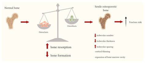 Bone Remodeling Osteoporosis