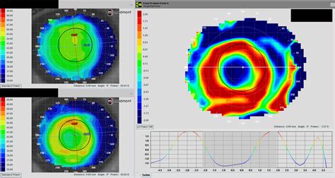 How Can Corneal Topography Aid In Orthokeratology Fitting Euclid