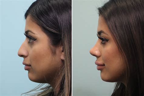 Rhinoplasty Photos Chevy Chase Md Patient