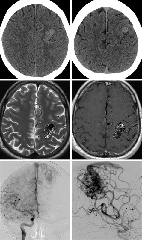 Arteriovenous Malformation The Neurosurgical Atlas