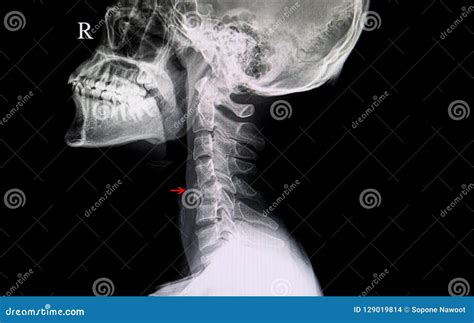 Fractured Cervical Spine Stock Photo Image Of Nerve