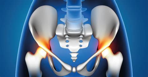 S Ntomas De La Artrosis De Cadera Orthokine