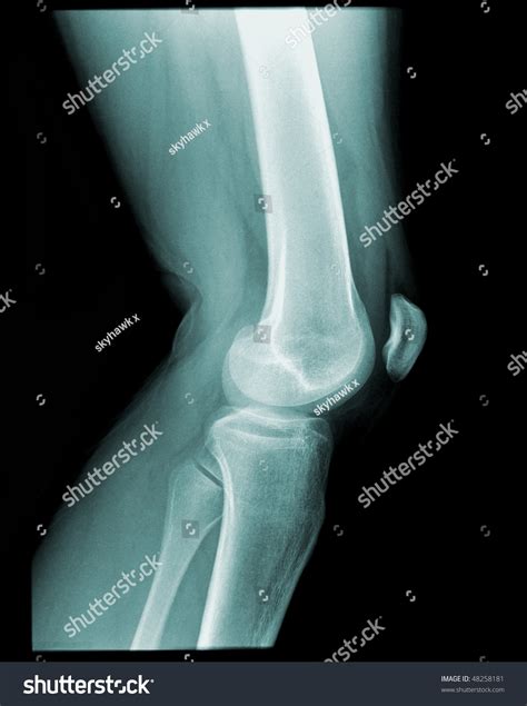 Xray Human Knee Side View On Stock Photo 48258181 | Shutterstock