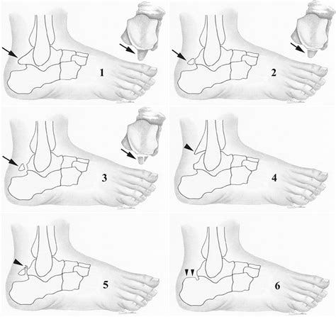 Mr Imaging Of Ankle Impingement Syndromes Ajr