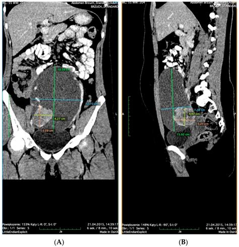 Diagnostics Free Full Text Papillary Thyroid Cancer In A Struma