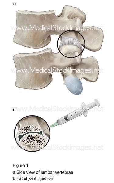 Lumbar Facet Joint Injection – Medical Stock Images Company