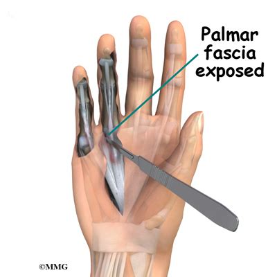 Fasciectomy