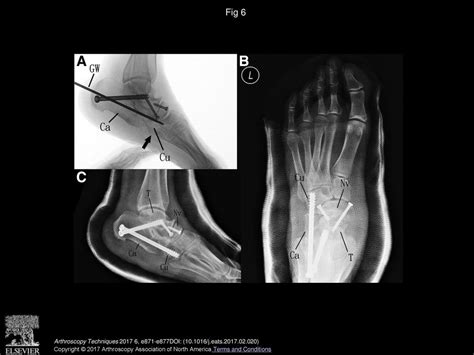 Arthroscopic Triple Arthrodesis In Management Of Chronic Flatfoot