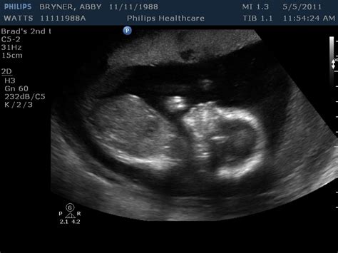 3d ultrasound 20 weeks boy