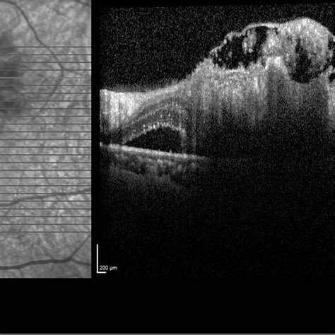 The Full Thickness Appearance Of The Retinal Metastasis Is Seen In Download Scientific Diagram