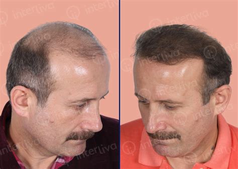 Hair Transplant Before And After Photos Interliva Hair