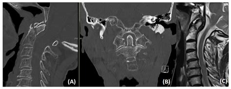 Odontoid Fracture X Ray