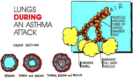 Asthma Attacks Department Of Pediatrics