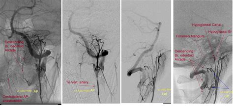 Ascending Pharyngeal Artery | neuroangio.org