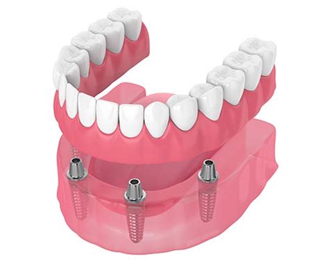 Prostodoncia en Valladolid Prótesis Dentales Clínica Galván