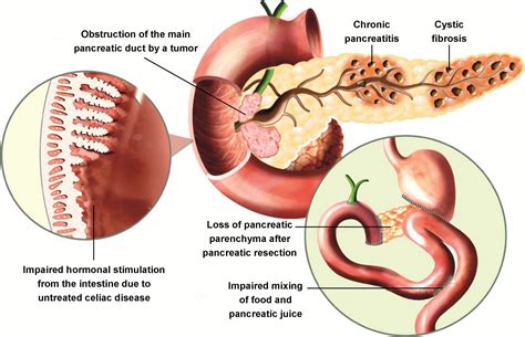 Introduction And Practical Approach To Exocrine Pancreatic Insufficiency For The Practicing