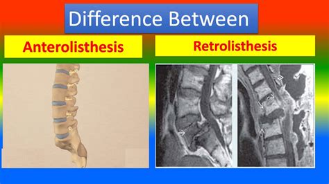 Difference Between Anterolisthesis and Retrolisthesis - YouTube