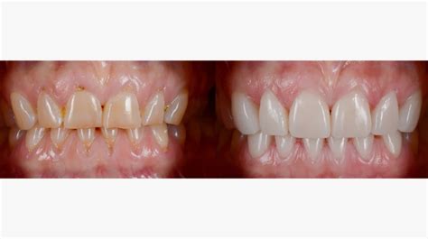 How Are Dental Veneers Applied Favourite Dentistry