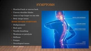 Kyphoscoliosis | PPT