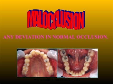 Classification Of Malocclusion In Orthodontics Certified Fixed Orthodontic Courses By Indian