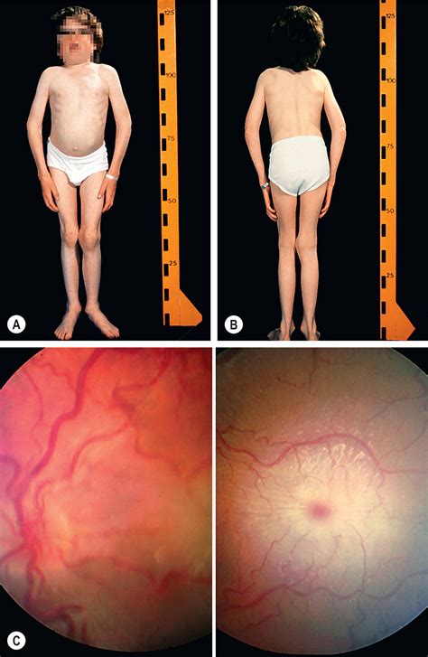 Neurometabolic Disease And The Eye Clinical Tree