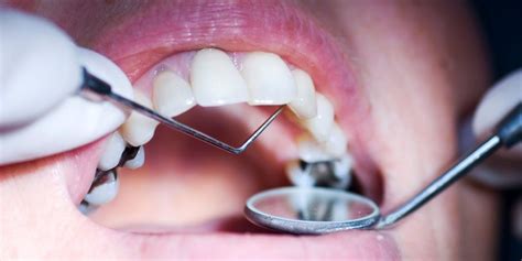 Let’s Understand the Tooth Cavity Treatment! - eLiveStory