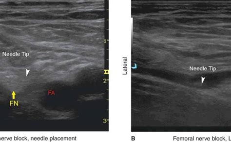 Ultrasound Guided Femoral Nerve Block Hadzic S Peripheral Nerve