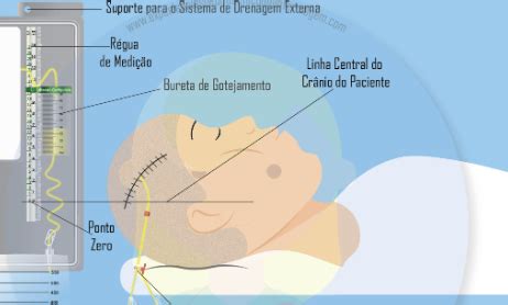 Deriva Ao Ventricular Externa