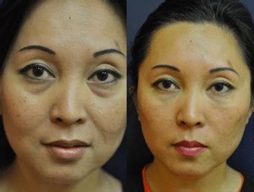 Belotero Injections Filler For Under Eyes Doctor Medica