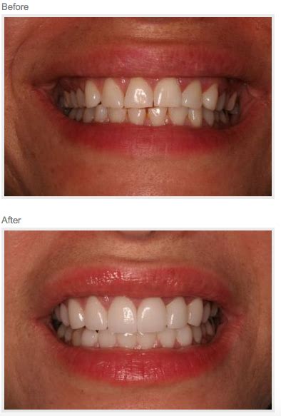 Smile Makeover Case Two