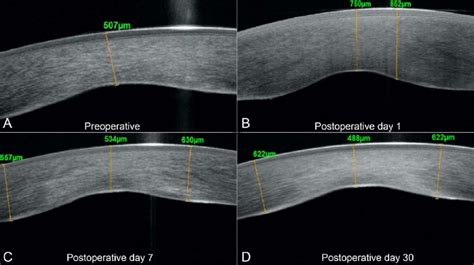 Imaged Through A Fourier Domain Optical Coherence Tomography Of Pa A