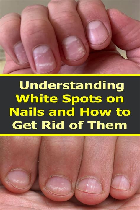 Understanding White Spots On Nails And How To Get Rid Of Them In 2024 White Spots On Nails