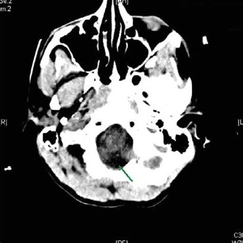 MRI brain on day 3. Both A and B (T1) show tonsillar herniation (green ...