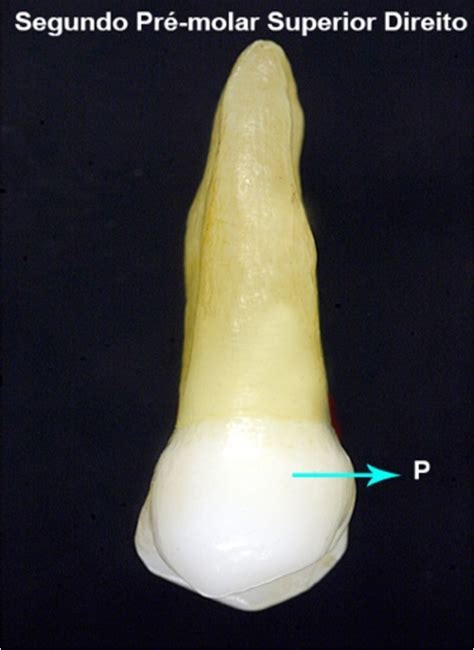 Face Palatina Do Segundo Pr Molar Superior Direito