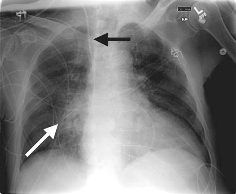 Pleurx Catheter Placement