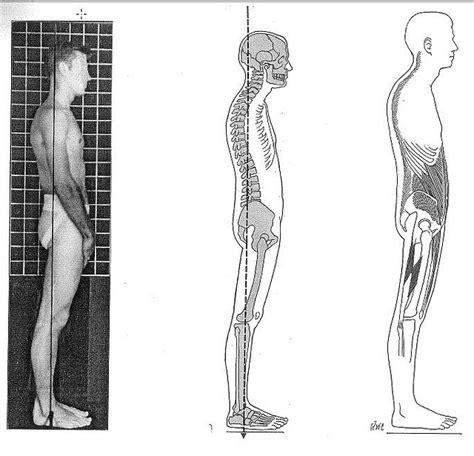 Sway Back Posture Description And Prescribed Exercises To Correct It